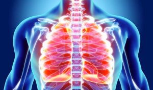 Kasus Pneumonia Menghantui Indonesia, Waspadai Peningkatan Kasus Pneumonia